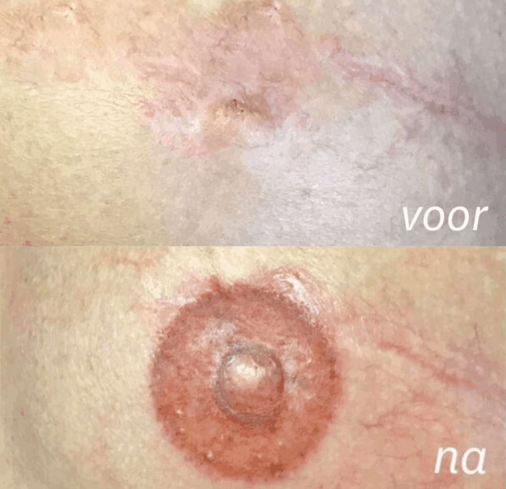 Voor en na foto van pigmentatie van de areola ofwel areola pigmentatie